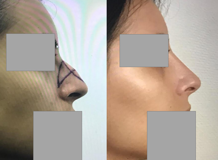 rhinoplastie reduction bosse nasale Chirurgie du nez dr marinetti