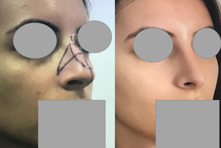 rhinoplastie reduction de toutes les dimensions du nez Chirurgie du nez dr marinetti