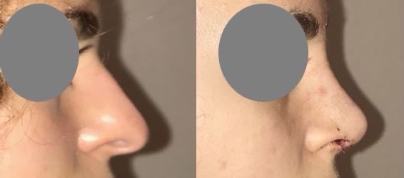 Rhinoplastie fermée pour réduction du nez à 10 jours à l?ablation du plâtre dr marinetti avril 2021