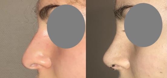 Rhinoplastie fermée pour réduction du nez à 10 jours à l?ablation du plâtre dr marinetti avril 2021