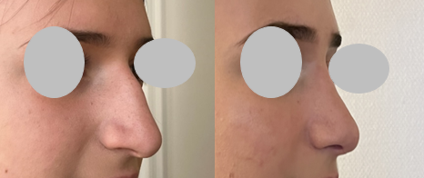 Rhinoplastie : suppression de la bosse et remontée de la pointe nasale