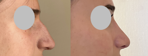 Rhinoplastie : suppression de la bosse et remontée de la pointe nasale