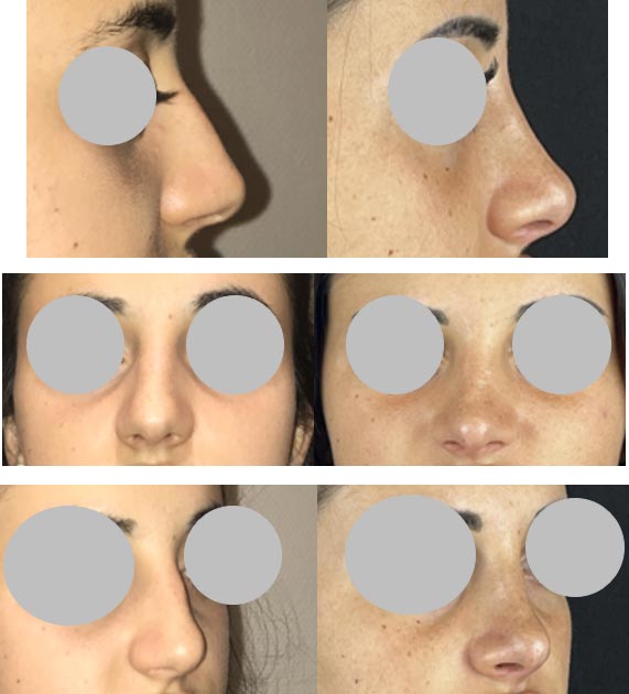 rhinoplastie