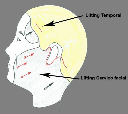 Lifting cervico facial