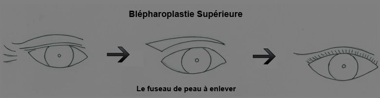 blepharoplastie marseille