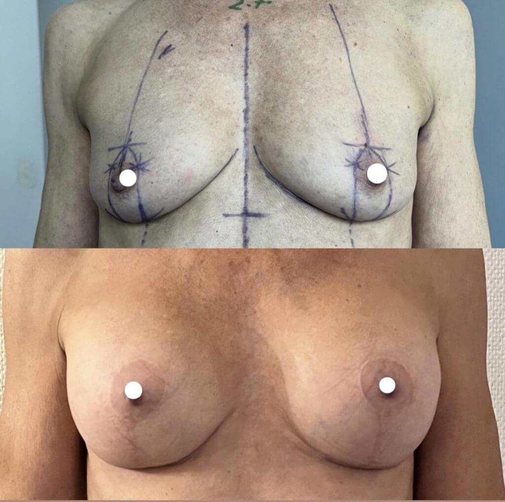 Implants mammaires et lifting des seins ptose