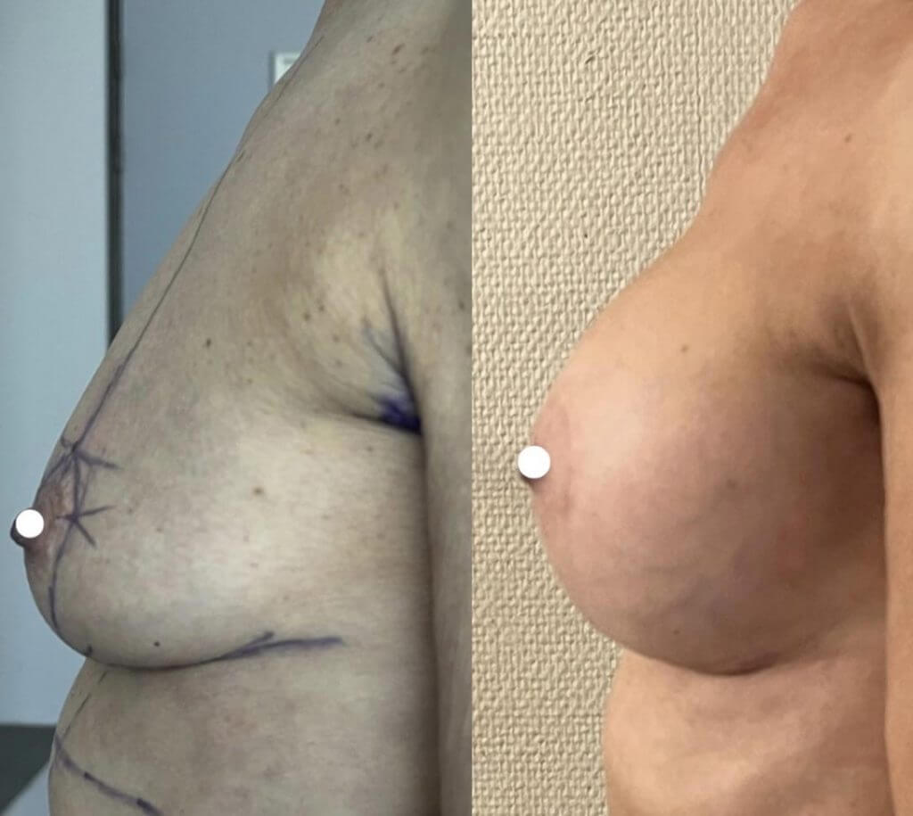 Implants mammaires et lifting des seins ptose