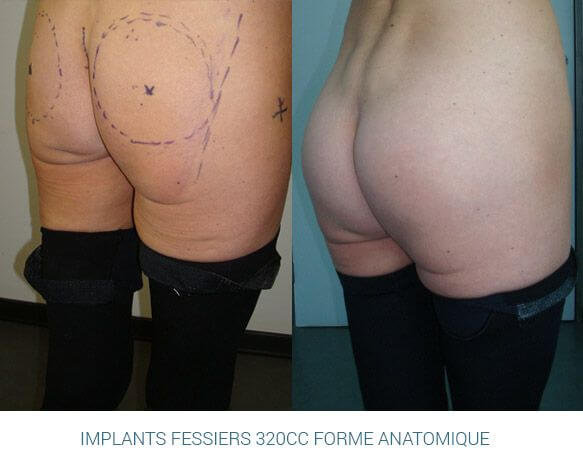 SIBOX_RUBRIQUE_61_implants-fessiers-marseille