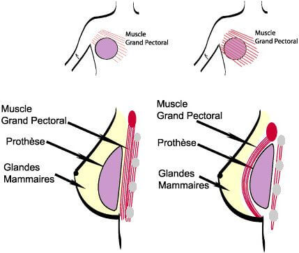 position implant mammaire devant ou derriere le muscle