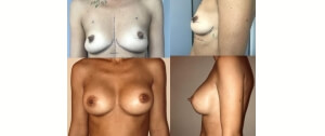 Ptose mammaire par seins vidés traitée par implants mammaires par voie axillaire sans cicatrice sur les seins